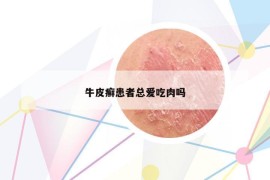 牛皮癣患者总爱吃肉吗