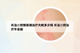 长治二院银屑病治疗大概多少钱 长治二院治疗牛皮癣