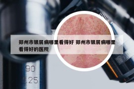 郑州市银屑病哪里看得好 郑州市银屑病哪里看得好的医院