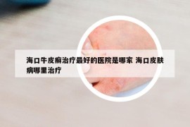 海口牛皮癣治疗最好的医院是哪家 海口皮肤病哪里治疗