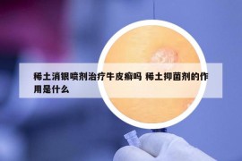 稀土消银喷剂治疗牛皮癣吗 稀土抑菌剂的作用是什么
