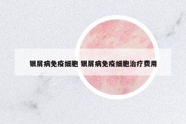 银屑病免疫细胞 银屑病免疫细胞治疗费用