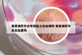银屑病怀孕会导致胎儿白血病吗 银屑病怀孕后会加重吗