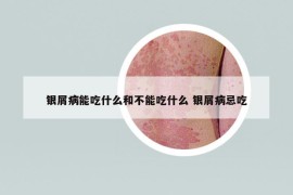 银屑病能吃什么和不能吃什么 银屑病忌吃