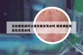 没有银屑病可以用乐银洗发水吗 银屑病能用采乐洗发水吗