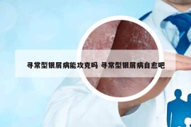 寻常型银屑病能攻克吗 寻常型银屑病自愈吧