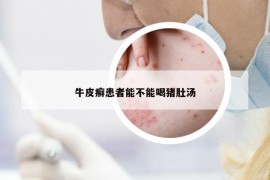 牛皮癣患者能不能喝猪肚汤