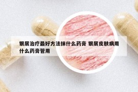 银屑治疗最好方法抹什么药膏 银屑皮肤病用什么药膏管用