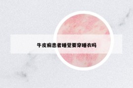 牛皮癣患者睡觉要穿睡衣吗
