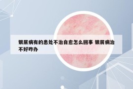 银屑病有的患处不治自愈怎么回事 银屑病治不好咋办