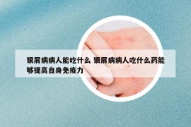 银屑病病人能吃什么 银屑病病人吃什么药能够提高自身免疫力