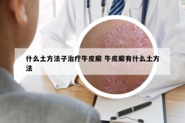 什么土方法子治疗牛皮廨 牛皮廨有什么土方法