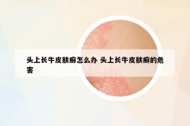 头上长牛皮肤癣怎么办 头上长牛皮肤癣的危害