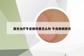 激光治疗牛皮癣效果怎么样 牛皮肤癣激光