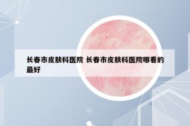 长春市皮肤科医院 长春市皮肤科医院哪看的最好