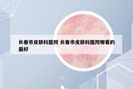 长春市皮肤科医院 长春市皮肤科医院哪看的最好