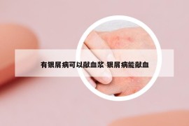 有银屑病可以献血浆 银屑病能献血
