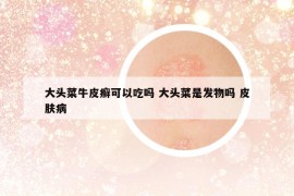 大头菜牛皮癣可以吃吗 大头菜是发物吗 皮肤病