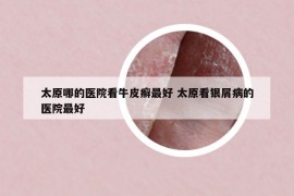 太原哪的医院看牛皮癣最好 太原看银屑病的医院最好