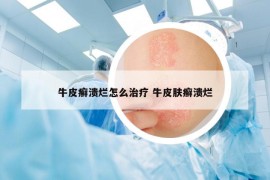 牛皮癣溃烂怎么治疗 牛皮肤癣溃烂