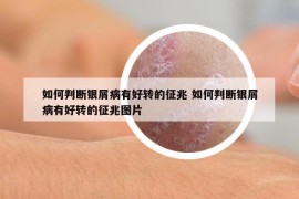 如何判断银屑病有好转的征兆 如何判断银屑病有好转的征兆图片