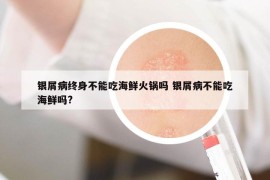 银屑病终身不能吃海鲜火锅吗 银屑病不能吃海鲜吗?
