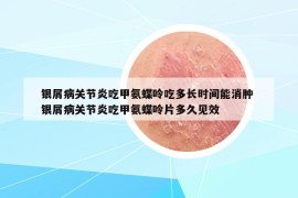 银屑病关节炎吃甲氨蝶呤吃多长时间能消肿 银屑病关节炎吃甲氨蝶呤片多久见效