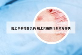 腿上长癣擦什么药 腿上长癣擦什么药好得快