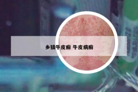 乡镇牛皮癣 牛皮病癣