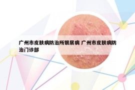 广州市皮肤病防治所银屑病 广州市皮肤病防治门诊部