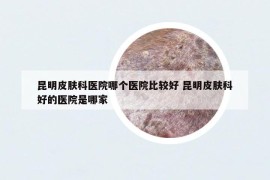 昆明皮肤科医院哪个医院比较好 昆明皮肤科好的医院是哪家