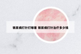 银屑病打针打哪里 银屑病打针治疗多少钱