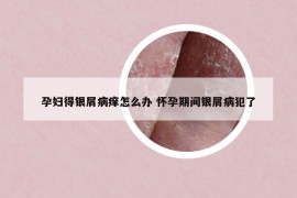 孕妇得银屑病痒怎么办 怀孕期间银屑病犯了