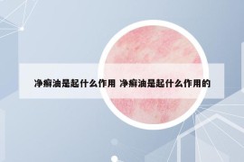 净癣油是起什么作用 净癣油是起什么作用的
