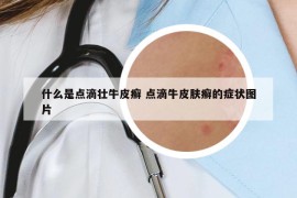 什么是点滴壮牛皮癣 点滴牛皮肤癣的症状图片