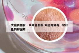 大腿内侧有一块红色的癣 大腿内侧有一块红色的癣图片