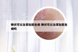 碘伏可以治掌趾脓包病 碘伏可以治掌趾脓包病吗