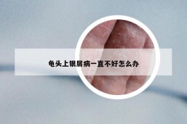 龟头上银屑病一直不好怎么办