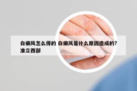 白癞风怎么得的 白癞风是什么原因造成的?准立西部