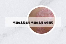 喝酒身上起疙瘩 喝酒身上起疙瘩图片