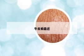 牛皮癣最近