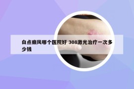 白点癫风哪个医院好 308激光治疗一次多少钱