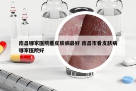 南昌哪家医院看皮肤病最好 南昌市看皮肤病哪家医院好