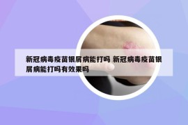 新冠病毒疫苗银屑病能打吗 新冠病毒疫苗银屑病能打吗有效果吗