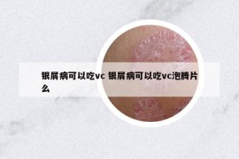银屑病可以吃vc 银屑病可以吃vc泡腾片么
