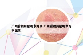 广州看银屑病哪家好啊 广州看银屑病哪家好啊医生