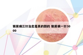 银屑病三针治愈是真的假的 银屑病一针3000