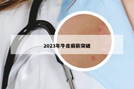 2023年牛皮癣新突破