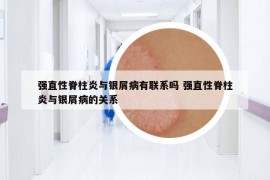 强直性脊柱炎与银屑病有联系吗 强直性脊柱炎与银屑病的关系