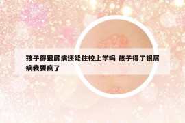 孩子得银屑病还能住校上学吗 孩子得了银屑病我要疯了